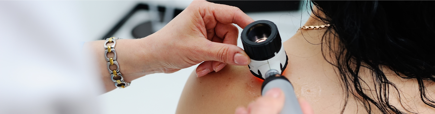 melanoma