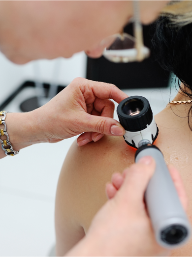 melanoma