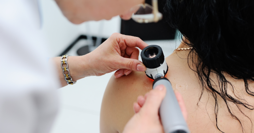 Melanoma